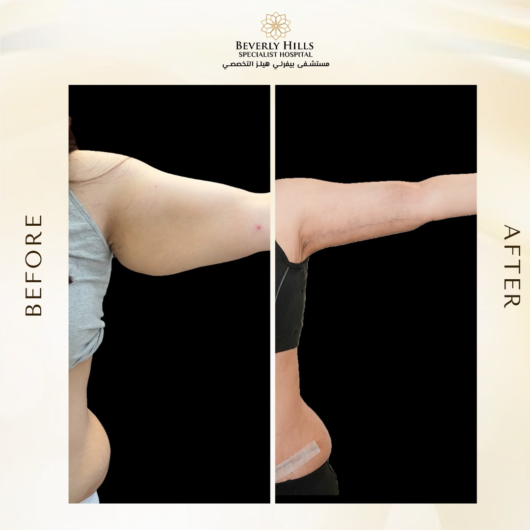 Arm Lift Surgery